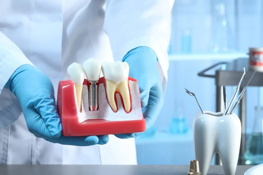 Dental Implants and their benefits